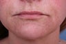 Evolence Collagen for Marionette Lines and Chin 