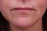 Evolence Collagen for Marionette Lines and Chin 