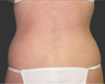 Exilis