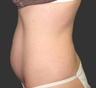 Exilis
