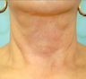Exilis