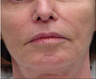Exilis