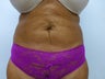 Exilis for skin tightening on post liposuction patient