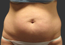 Exilis