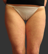 Exilis