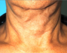 Exilis