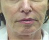 Exilis