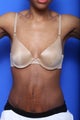 Exilis Skin Tightening