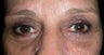 Eye Bags Treatment
