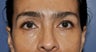 Eye Bags Treatment