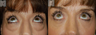 Blepharoplasty