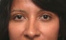 Lower blepharoplasty