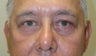 Blepharoplasty