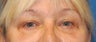 Lower Blephoplasty