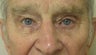 Upper Ptosis repair and Lower Blepharoplasty and Cheek Lift 