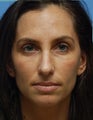 Eye Dermafillers,Cheek Dermafillers,Facial Dermafillers 