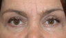 Eye Bags Treatment