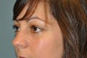 Lower Blepharoplasty