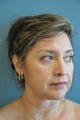Lower Blepharoplasty