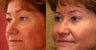 Eyelid Surgery or blepharoplasty 