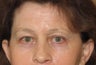 Eyelid surgery - blepharoplasty