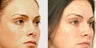 Non Surgical Liquid Eyelid Lift