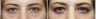 36 year old female with lower eyelid bags