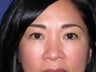 Eye bags treatment: Fat transfer to tear troughs