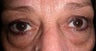 Eye Bags Treatment