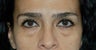 Eye Bags Treatment