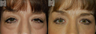 Blepharoplasty