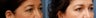 Lower Blepharoplasty
