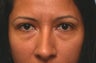 Lower blepharoplasty