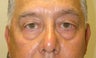 Blepharoplasty