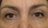 Eye Bags Treatment