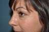 Lower Blepharoplasty