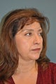 Lower Blepharoplasty