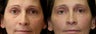 Eyelid surgery or blepharoplasty