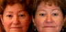 Eyelid Surgery or blepharoplasty 