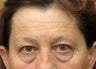 Eyelid surgery - blepharoplasty