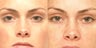 Non Surgical Liquid Eyelid Lift