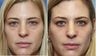 36 year old female with lower eyelid bags