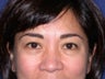 Eye bags treatment: Fat transfer to tear troughs