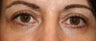 Eyelid Surgery