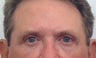 Eyelid Surgery