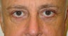 Eyelid Surgery