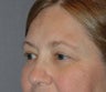 Eyelid Surgery