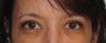 Eyelid Surgery