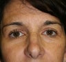 Blepharoplasty