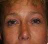 Blepharoplasty, Rhinoplasty and Brow Lift